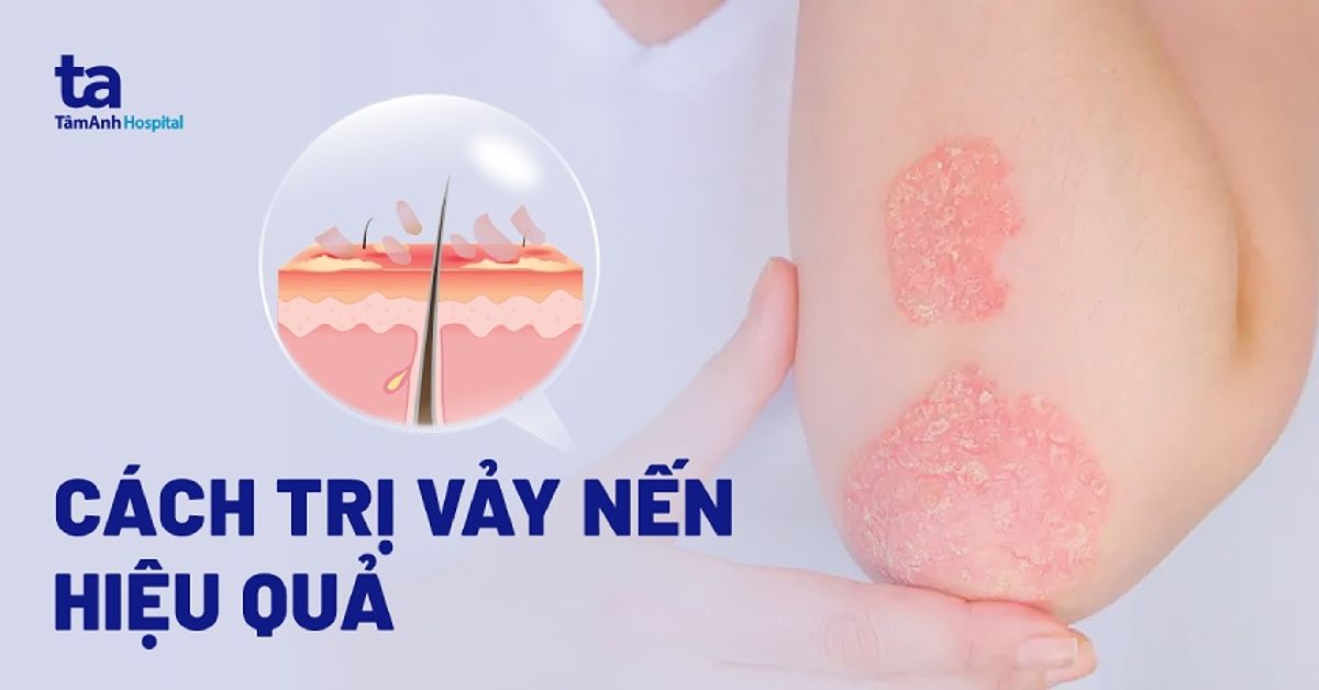 Cách trị vảy nến