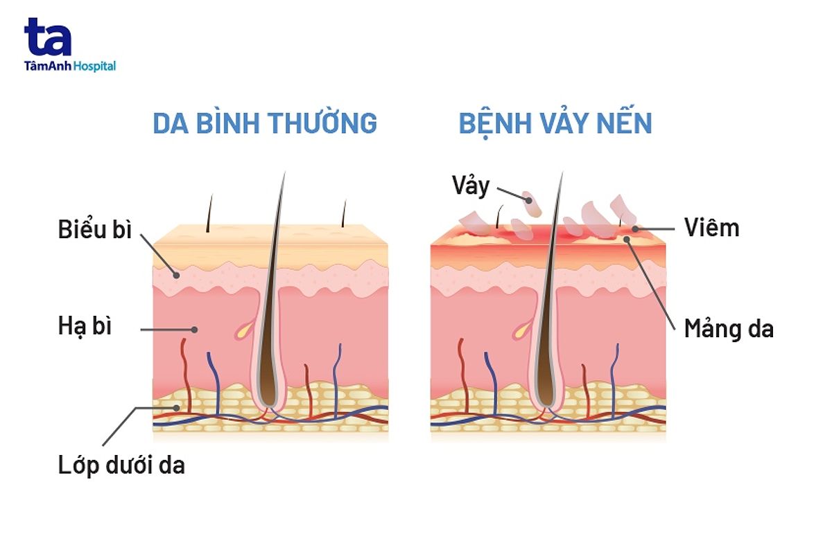 Trải nghiệm cá nhân với UVB 311nm